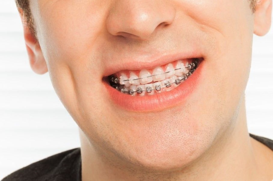 Traditional Braces Benefits