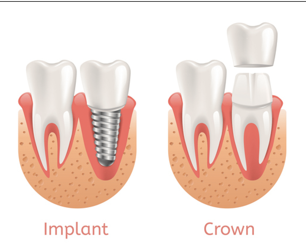 Dental Implant vs Dental Crown by rockford dentist
