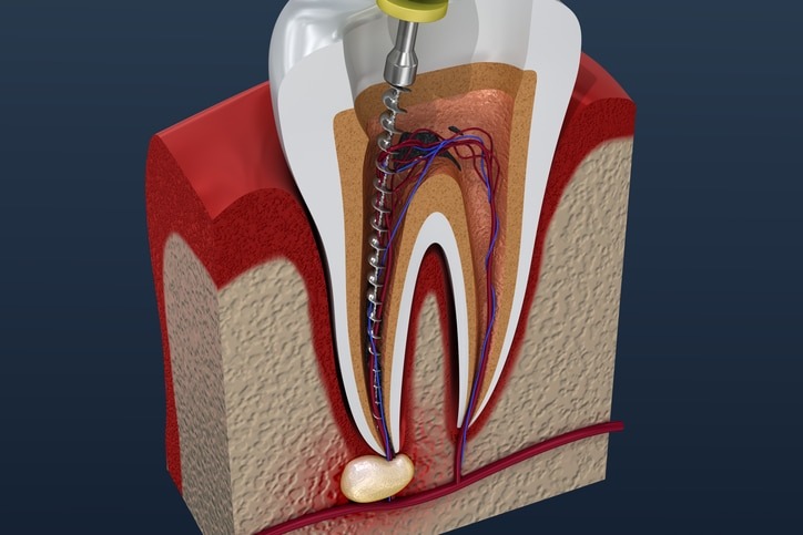 Root canal rockford dentist treatment process by dentist in rockford il