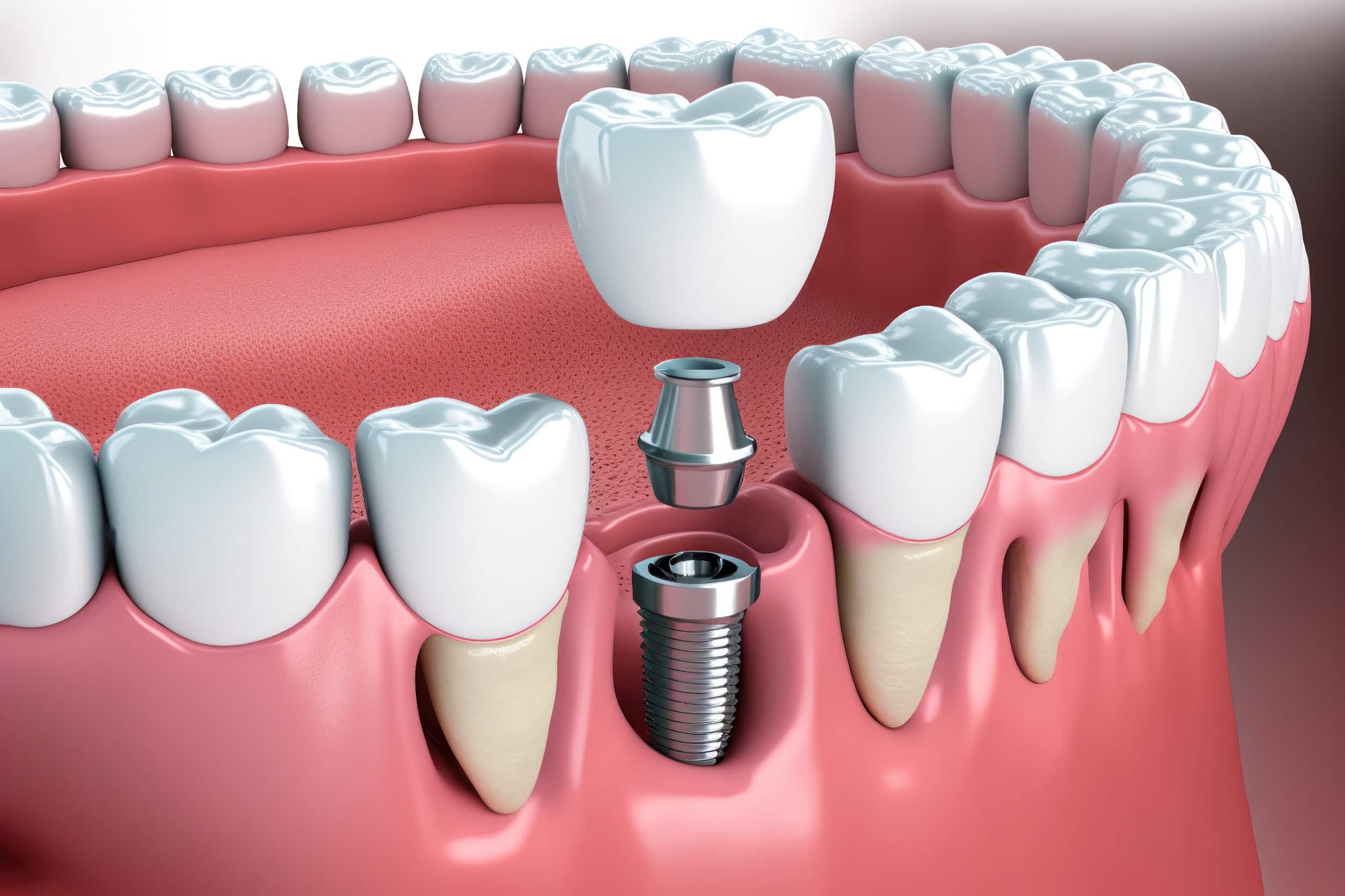 best dental implants rockford