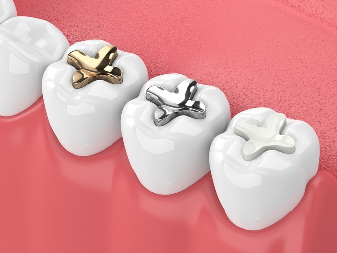 Tooth Filling Rockford IL